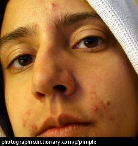 Photo of a teenager with pimples