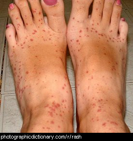 Photo of some feet with a rash