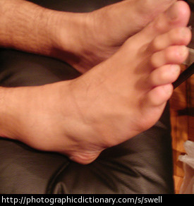 A swollen ankle compared to a normal ankle.