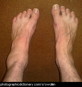 Photo of a man with a swollen ankle
